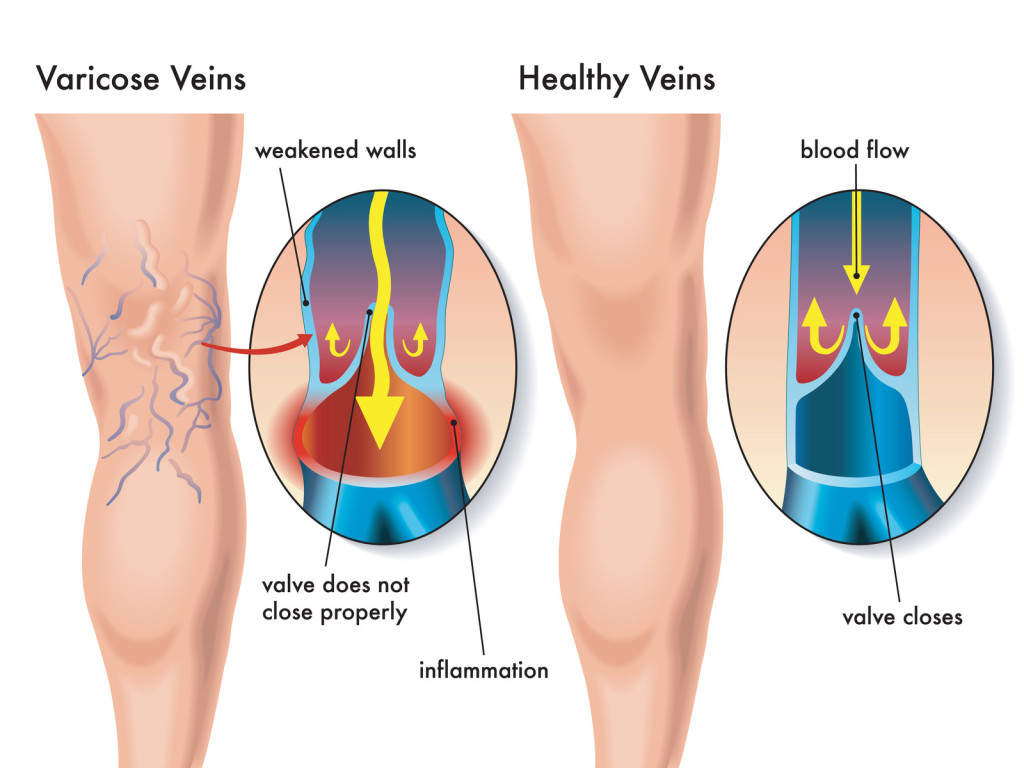 varicose veins diagnosis