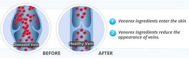 Venorex varicose veins treatment cream
