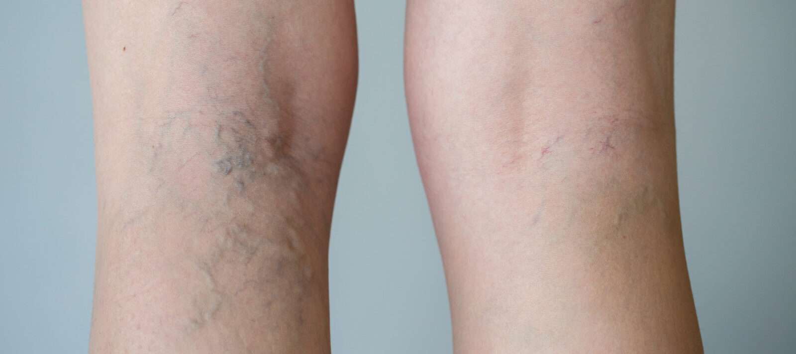 How Much Does Varicose Vein Treatment Cost Without Insurance?