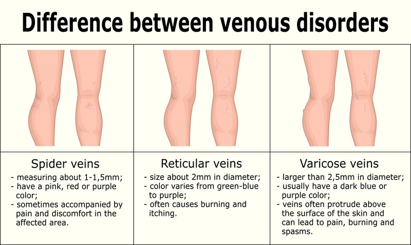 How To Get Rid Of Varicose Veins And Spider Veins Naturally