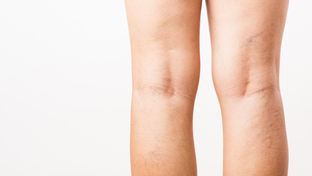 When Are You At Greatest Risk Of Varicose Veins